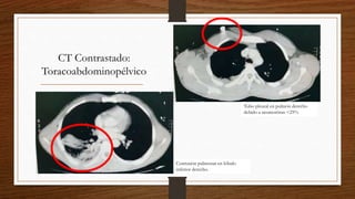 CT Contrastado:
Toracoabdominopélvico
Tubo pleural en pulmón derecho
debido a neumotórax <25%
Contusión pulmonar en lóbulo
inferior derecho.
 