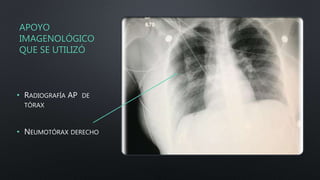 APOYO
IMAGENOLÓGICO
QUE SE UTILIZÓ
• RADIOGRAFÍA AP DE
TÓRAX
• NEUMOTÓRAX DERECHO
 