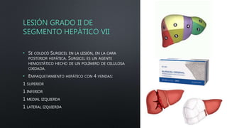 LESIÓN GRADO II DE
SEGMENTO HEPÁTICO VII
• SE COLOCÓ SURGICEL EN LA LESIÓN, EN LA CARA
POSTERIOR HEPÁTICA. SURGICEL ES UN AGENTE
HEMOSTÁTICO HECHO DE UN POLÍMERO DE CELULOSA
OXIDADA.
• EMPAQUETAMIENTO HEPÁTICO CON 4 VENDAS:
1 SUPERIOR
1 INFERIOR
1 MEDIAL IZQUIERDA
1 LATERAL IZQUIERDA
 