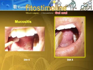 DIA 0 DIA 5
Mucositis
 