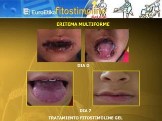 DIA O
DIA 7
TRATAMIENTO FITOSTIMOLINE GEL
ERITEMA MULTIFORME
 