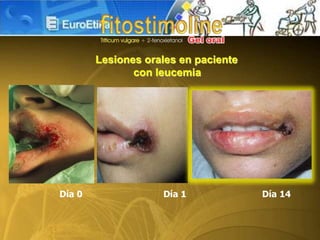 Lesiones orales en paciente
con leucemia
Día 0 Día 1 Día 14
 