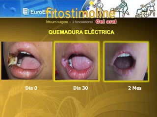 Día 0 Día 30 2 Mes
QUEMADURA ELÉCTRICA
 