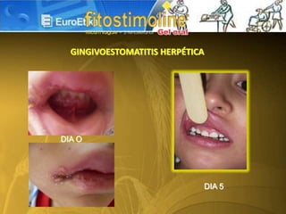 GINGIVOESTOMATITIS HERPÉTICA
DIA 5
DIA O
 