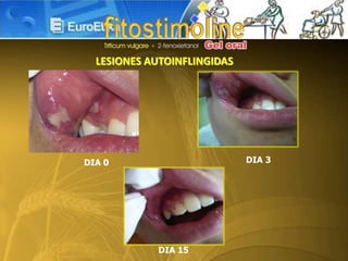 LESIONES AUTOINFLINGIDAS
DIA 15
DIA 3DIA 0
 