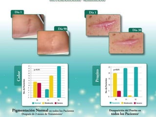 Curso Úlceras por Presión