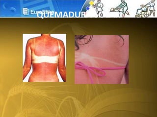 QUEMADURA SOLAR
 
