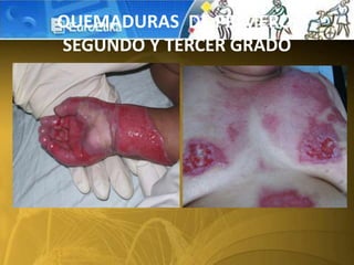 QUEMADURAS DE PRIMERO,
SEGUNDO Y TERCER GRADO
 
