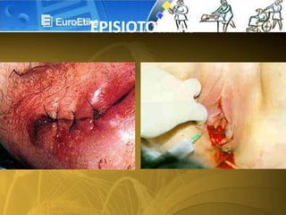 EPISIOTOMIAS
 