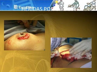 HERIDAS POR CIRUGIA
 