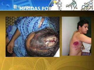 HERIDAS POR TRAUMA
 