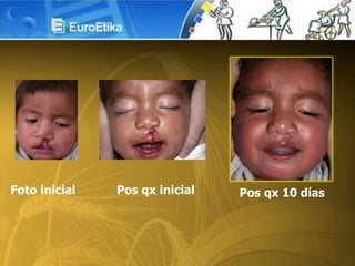 Foto inicial Pos qx inicial Pos qx 10 días
 