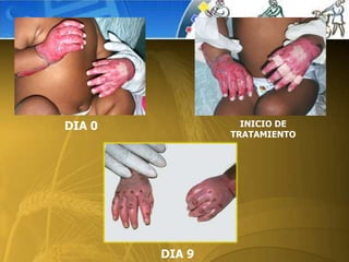 DIA 0
DIA 9
INICIO DE
TRATAMIENTO
 