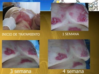 1 SEMANA
3 semana
INICIO DE TRATAMIENTO
4 semana
 