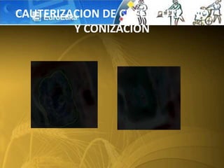 CAUTERIZACION DE CUELLO UTERINO
Y CONIZACION
 
