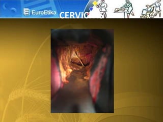 CERVICITIS
 
