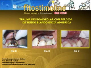Dia 0 Dia 3 Dia 7
TRAUMA DENTOALVEOLAR CON PÉRDIDA
DE TEJIDO BLANDO ENCÍA ADHERIDA
Cortesía seguimientos clínicos
Dra. Eliana E. Muñoz
Estomatóloga y Cirujana Oral
Hospital Infantil Universitario de Manizales
 