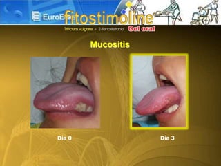 Día 0 Día 3
Mucositis
 