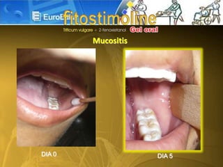 Mucositis
DIA 0 DIA 5
 