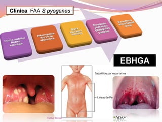 EBHGA
Clínica FAA S pyogenes
Esther Bernal
 