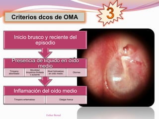 Inflamación del oído medio
Tímpano eritematoso Otalgia franca
Presencia de líquido en oído
medio
Tímpano
abombado
Movilidad
timpánica limitada
o ausente
Nivel hidroaéreo
en oído medio
Otorrea
Inicio brusco y reciente del
episodio
Criterios dcos de OMA
Esther Bernal
 