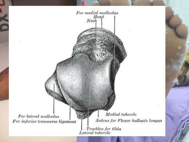 Talus Slides Talus body fracture management | PPT