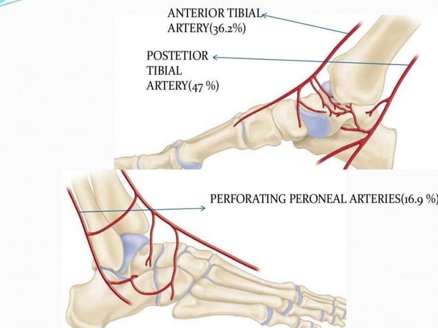 Talus body fracture management | PPT