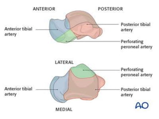 Talus body fracture management | PPT