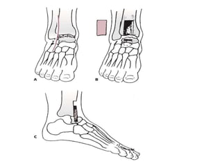 Talus body fracture management | PPT