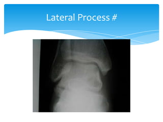 Lateral Processes Talus anatomy, blood supply & fractures | PPTX