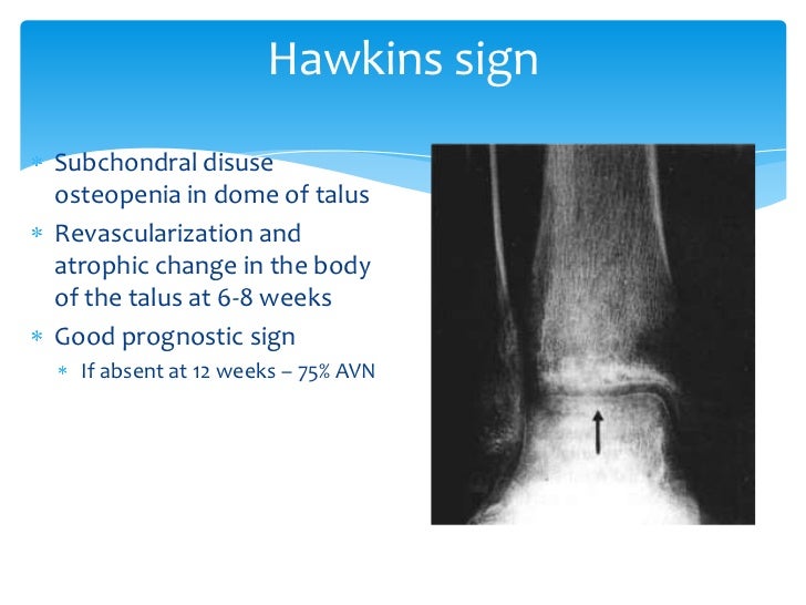 Talus anatomy, blood supply & fractures