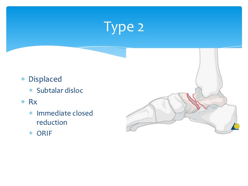 Talus anatomy, blood supply & fractures