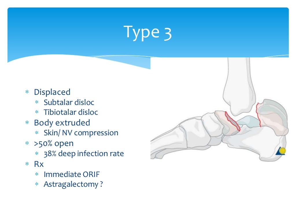 Talus anatomy, blood supply & fractures
