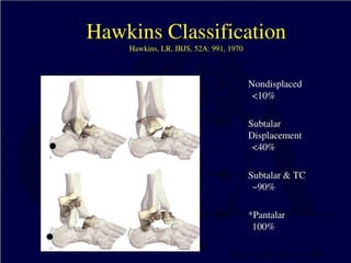 Talus Dislocation Talus+Fractures and subtalar dislocations.pptx