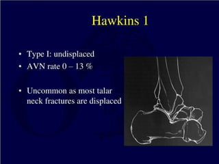 Talus Dislocation Talus+Fractures and subtalar dislocations.pptx