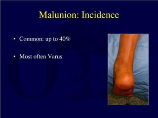 Talus+Fractures and subtalar dislocations.pptx