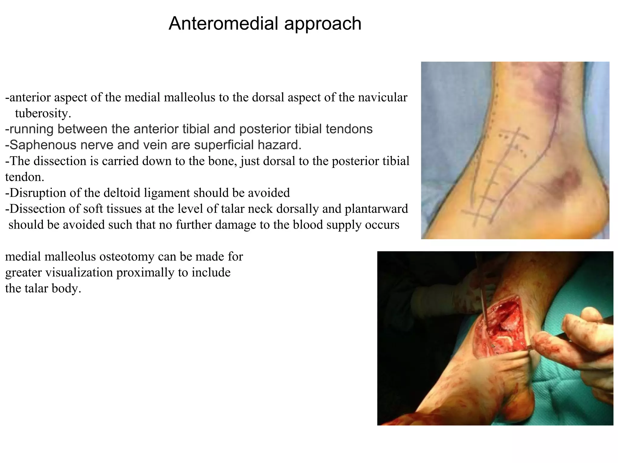 Talus fructures classification and managment | PPTX