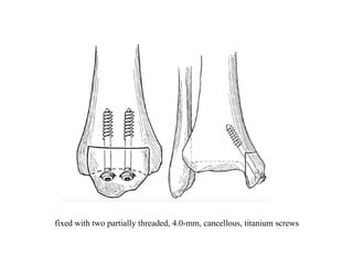 fixed with two partially threaded, 4.0-mm, cancellous, titanium screws
 