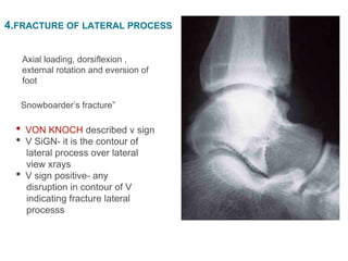 • VON KNOCH described v sign
• V SiGN- it is the contour of
lateral process over lateral
view xrays
• V sign positive- any
disruption in contour of V
indicating fracture lateral
processs
Snowboarder’s fracture”
Axial loading, dorsiflexion ,
external rotation and eversion of
foot
4.FRACTURE OF LATERAL PROCESS
 