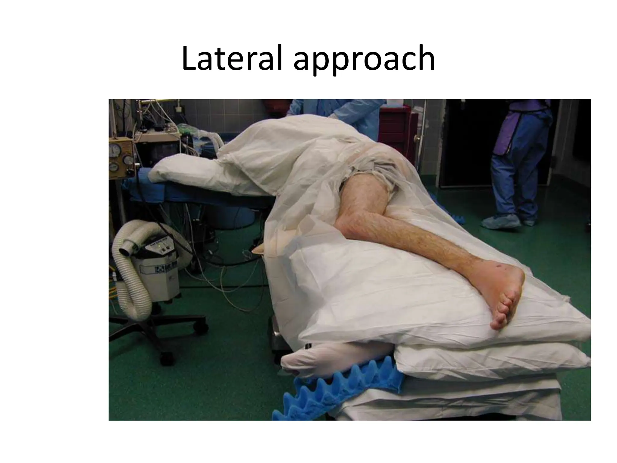 Lateral approach
 