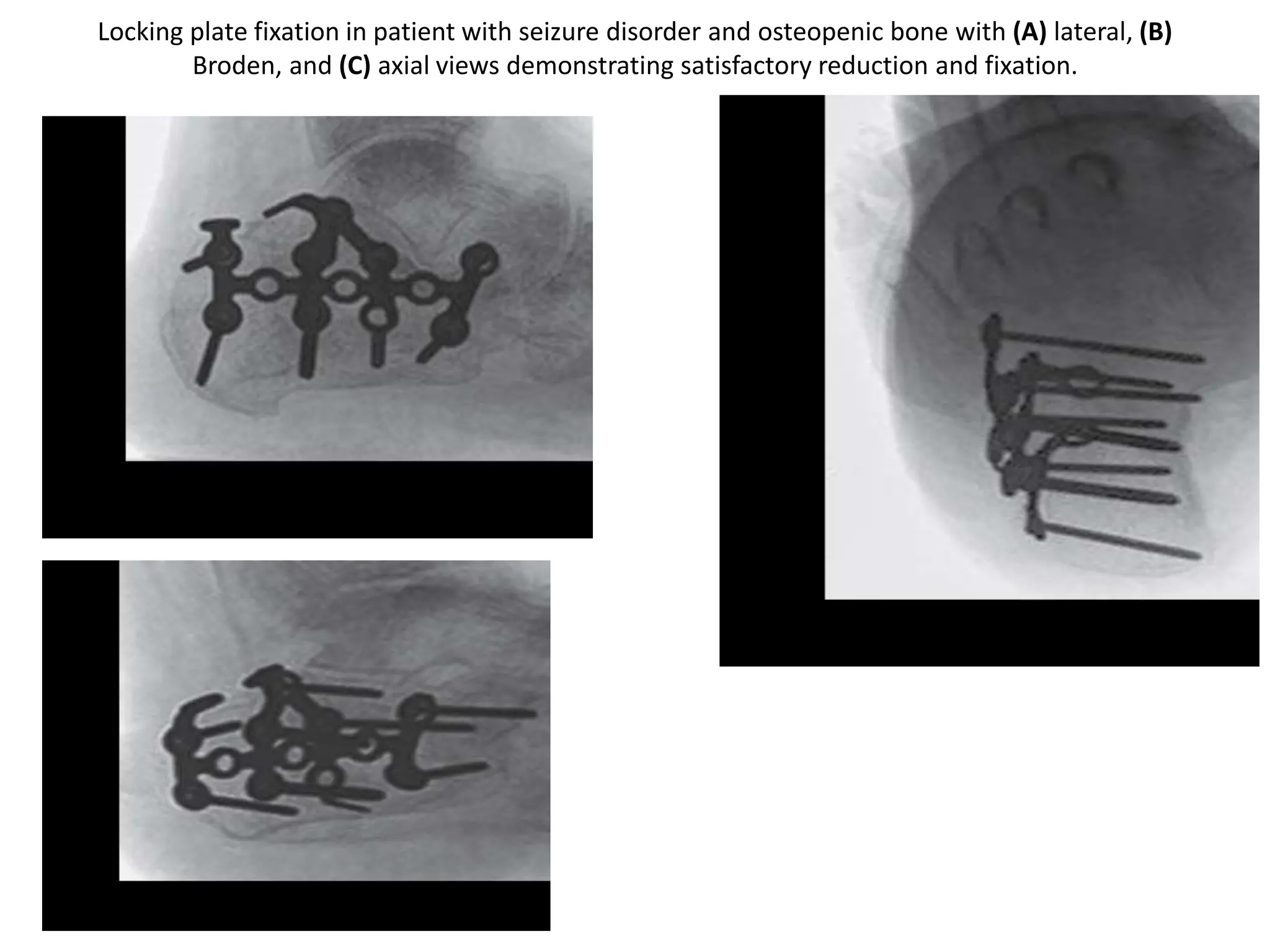 Locking plate fixation in patient with seizure disorder and osteopenic bone with (A) lateral, (B)
Broden, and (C) axial views demonstrating satisfactory reduction and fixation.
 