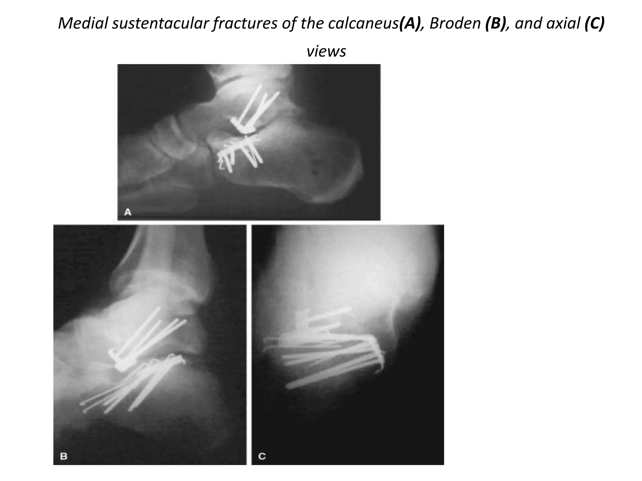 Medial sustentacular fractures of the calcaneus(A), Broden (B), and axial (C)
views
 