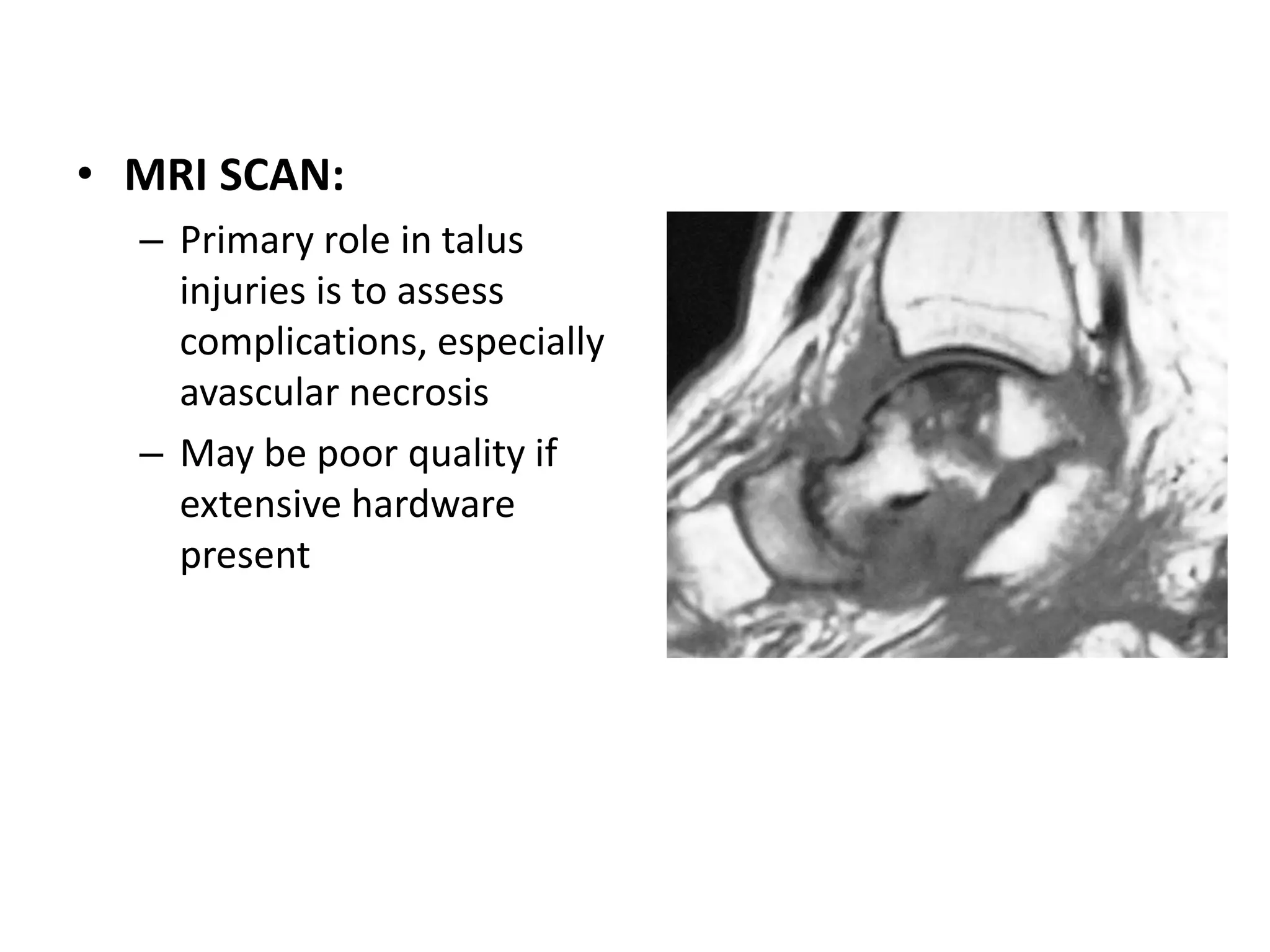 • MRI SCAN:
– Primary role in talus
injuries is to assess
complications, especially
avascular necrosis
– May be poor quality if
extensive hardware
present
 