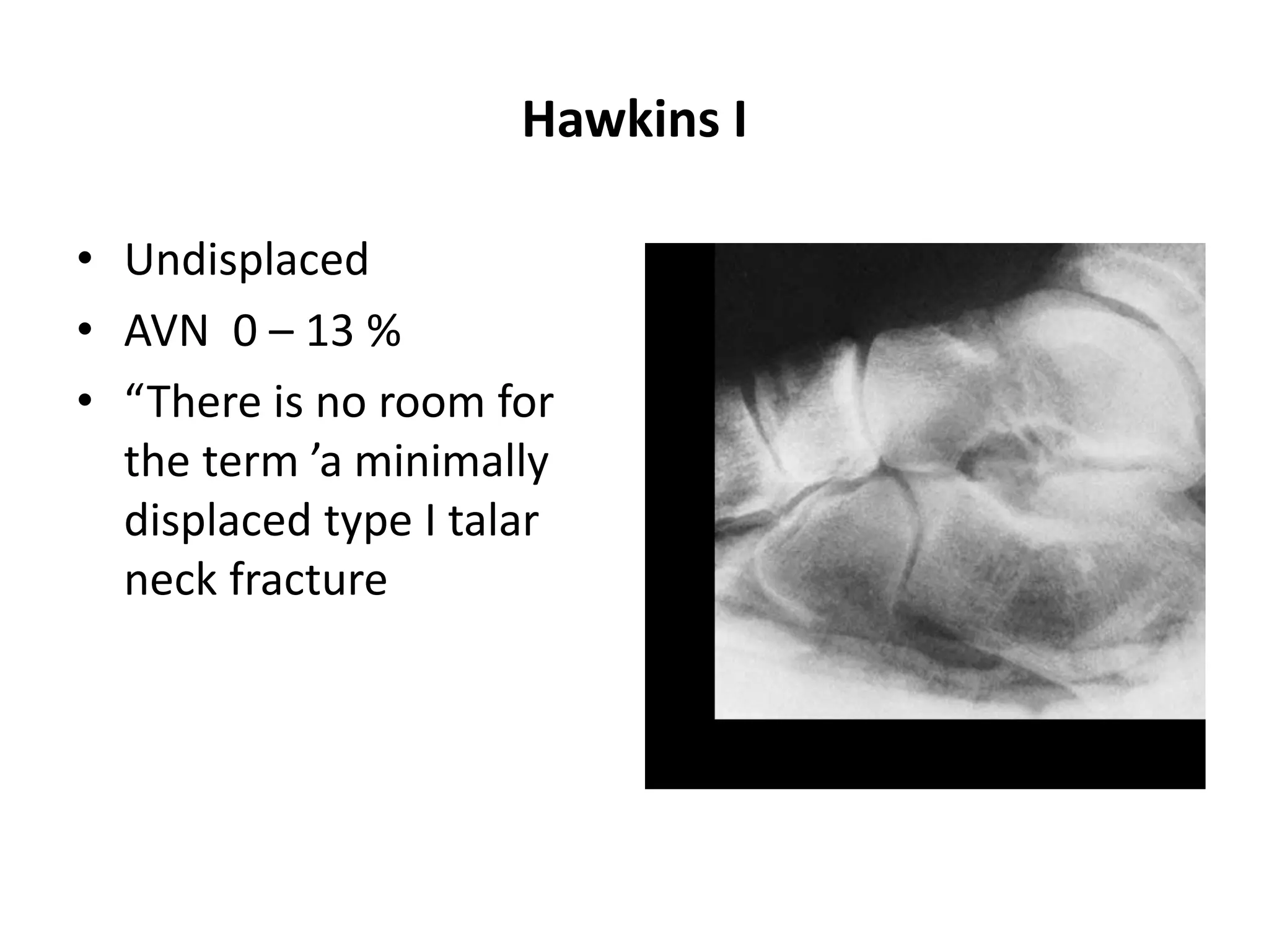 Hawkins I
• Undisplaced
• AVN 0 – 13 %
• “There is no room for
the term ’a minimally
displaced type I talar
neck fracture
 