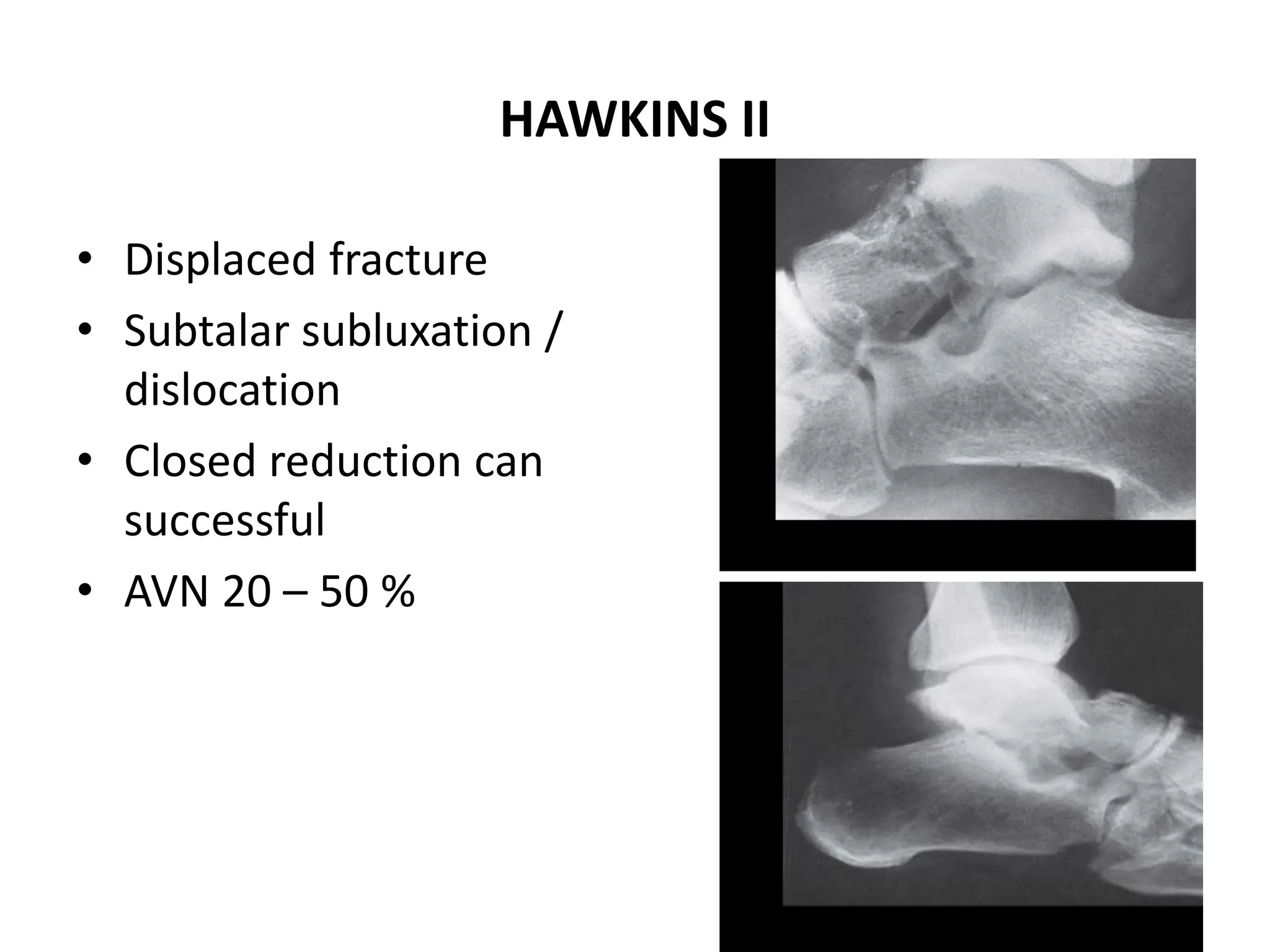 HAWKINS II
• Displaced fracture
• Subtalar subluxation /
dislocation
• Closed reduction can
successful
• AVN 20 – 50 %
 