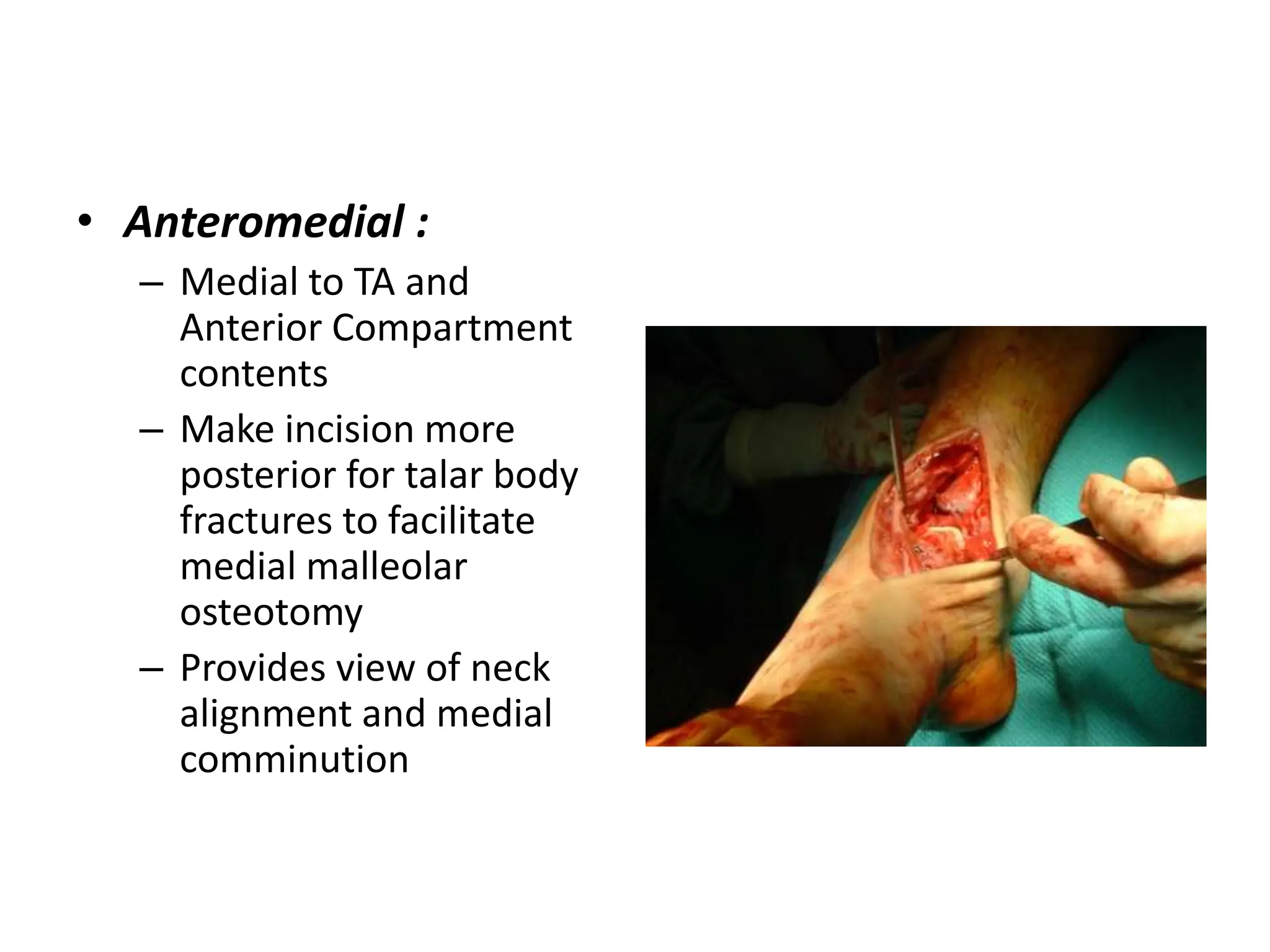 • Anteromedial :
– Medial to TA and
Anterior Compartment
contents
– Make incision more
posterior for talar body
fractures to facilitate
medial malleolar
osteotomy
– Provides view of neck
alignment and medial
comminution
 