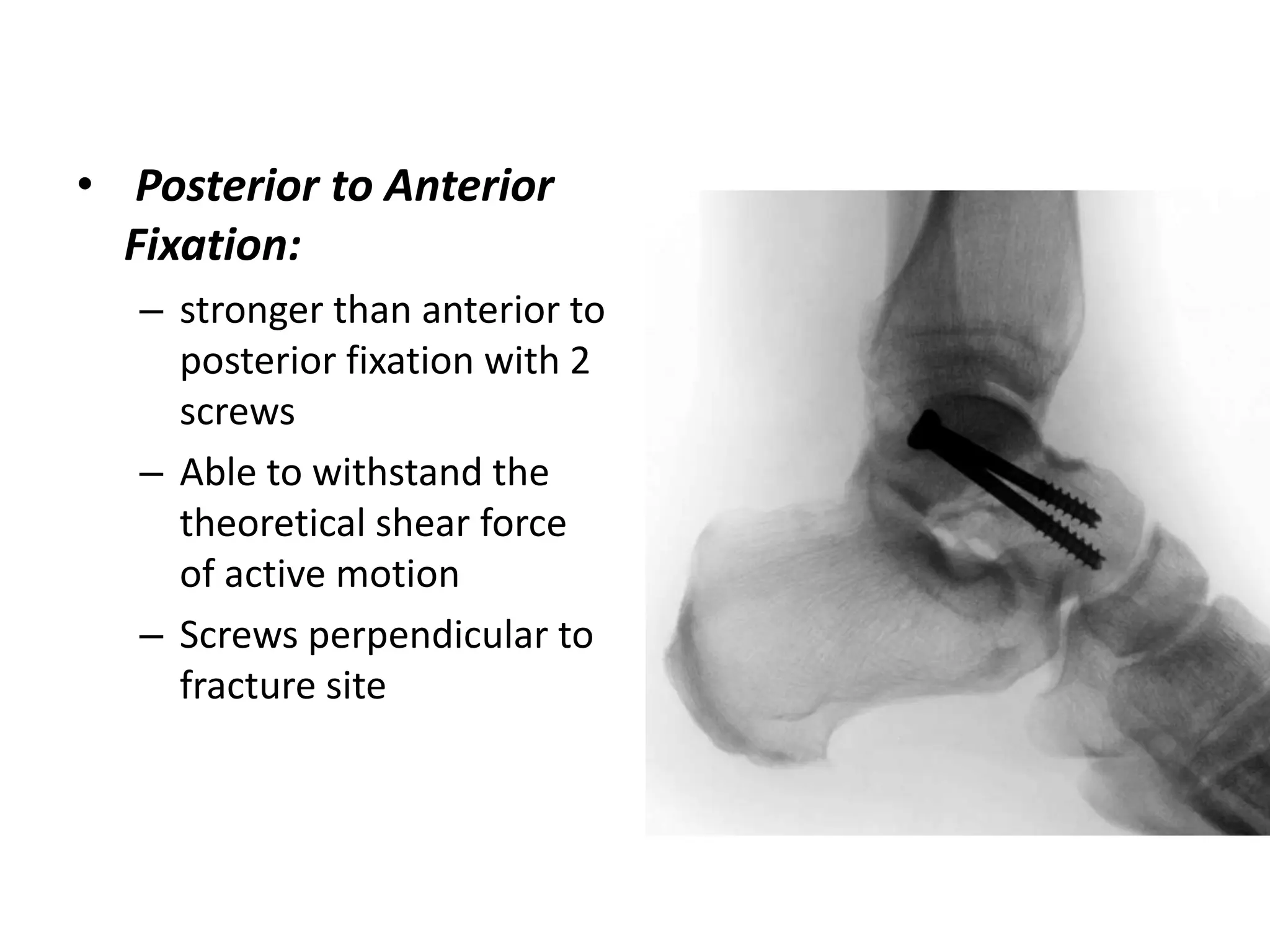 • Posterior to Anterior
Fixation:
– stronger than anterior to
posterior fixation with 2
screws
– Able to withstand the
theoretical shear force
of active motion
– Screws perpendicular to
fracture site
 