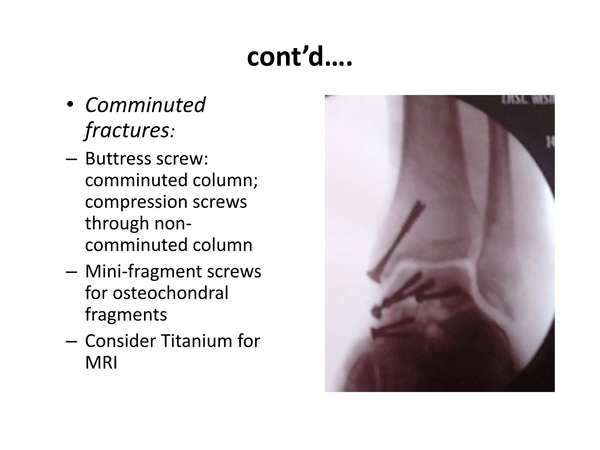 cont’d….
• Comminuted
fractures:
– Buttress screw:
comminuted column;
compression screws
through non-
comminuted column
– Mini-fragment screws
for osteochondral
fragments
– Consider Titanium for
MRI
 