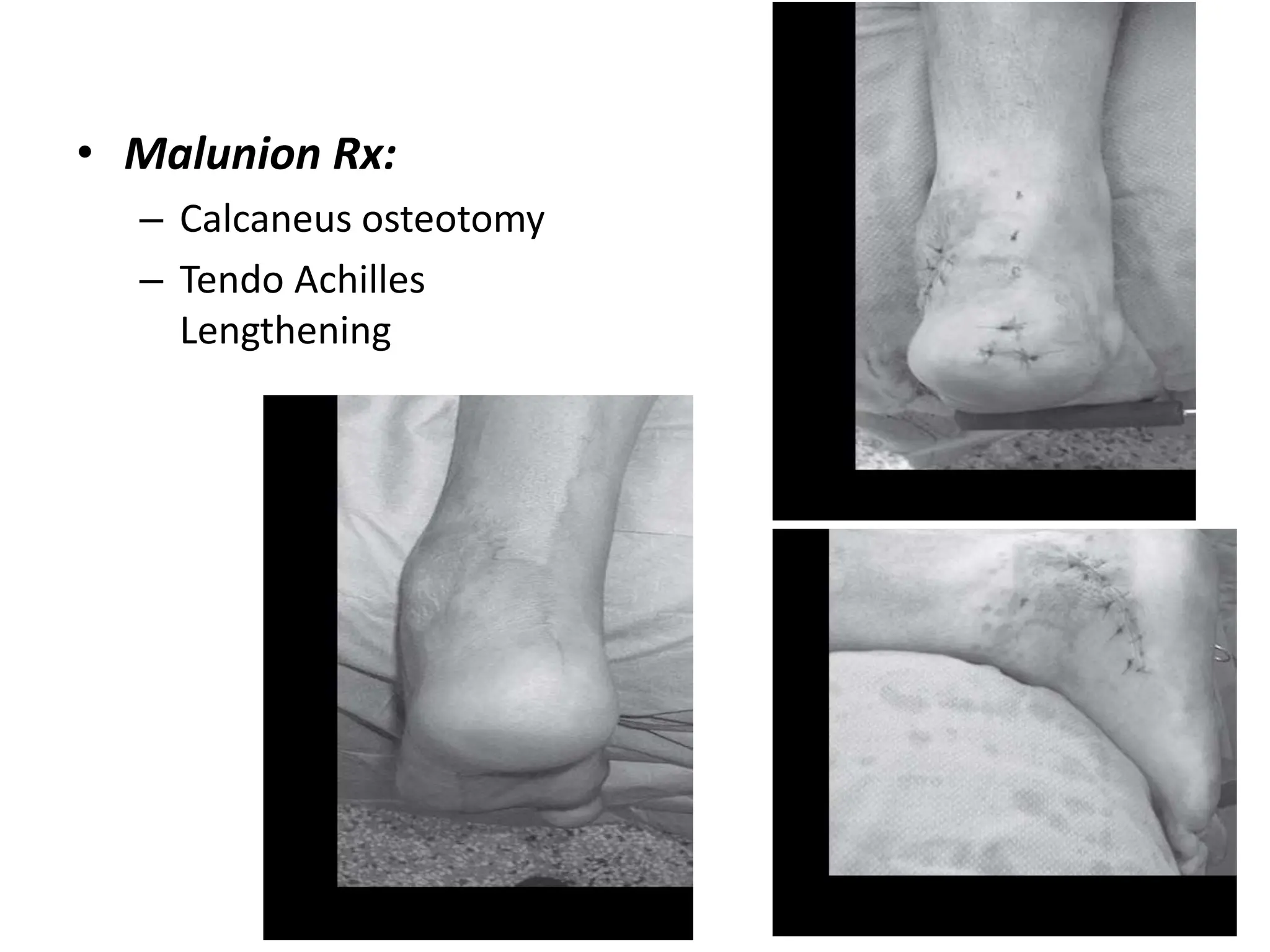 • Malunion Rx:
– Calcaneus osteotomy
– Tendo Achilles
Lengthening
 