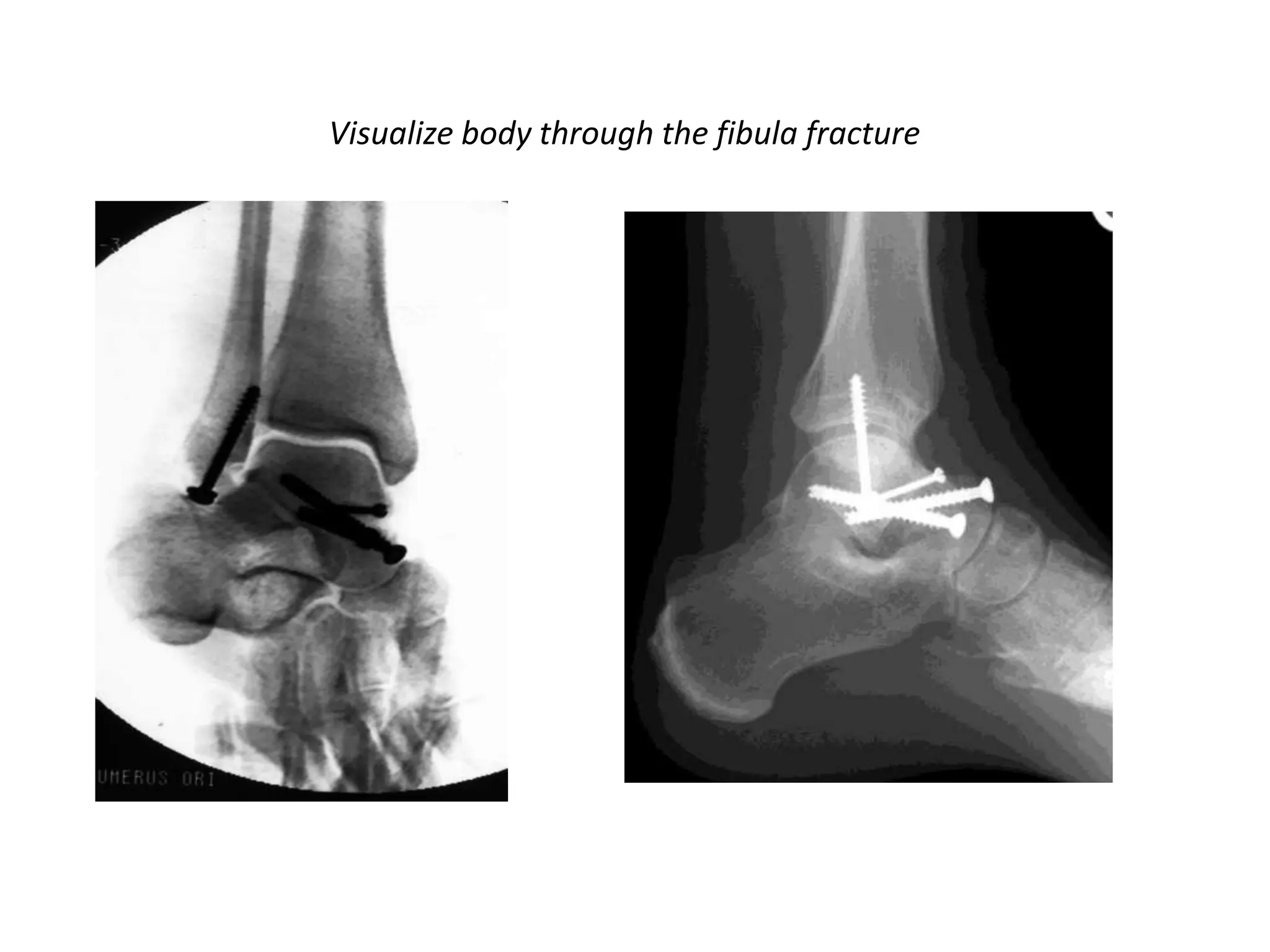 Visualize body through the fibula fracture
 
